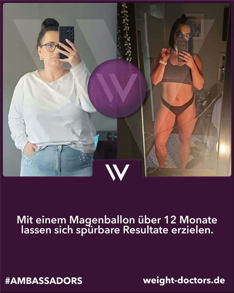 Weight Doctors® Vorher-Nachher: Patientin vor und nach zwölf Monaten mit dem Weight Doctors® MAGENBALLON