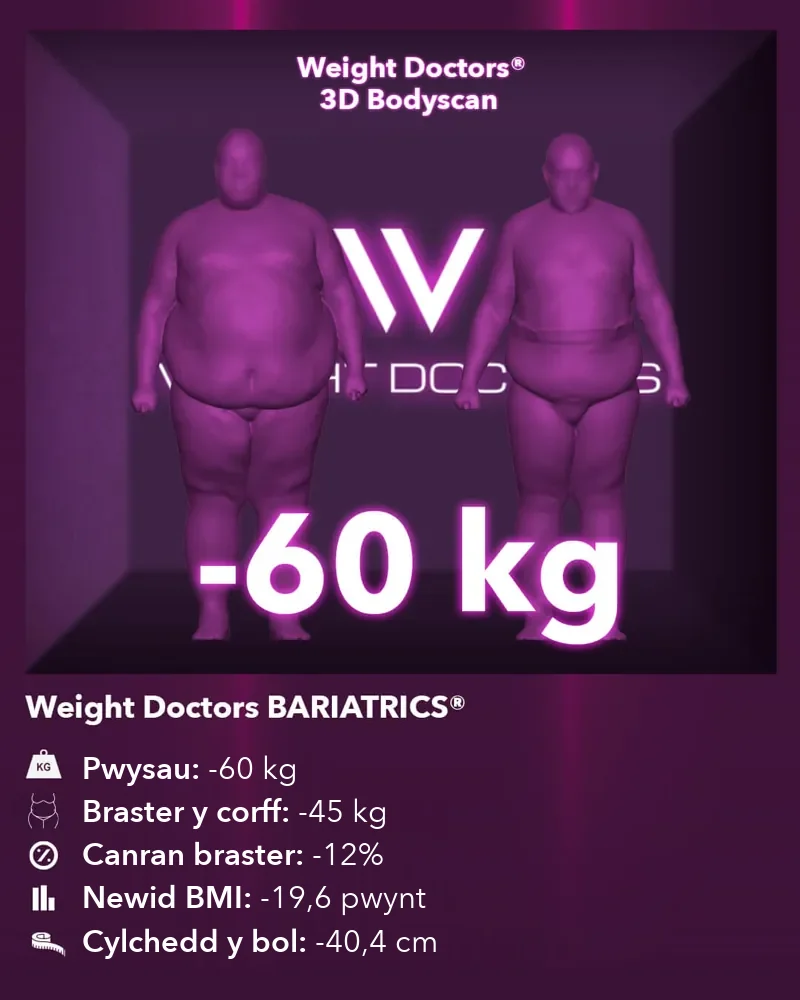 Weight Doctors® 3D Bodyscan cyn ac ar ôl: minws 60 kg gyda Weight Doctors BARIATRICS®, braster y corff minws 45 kg