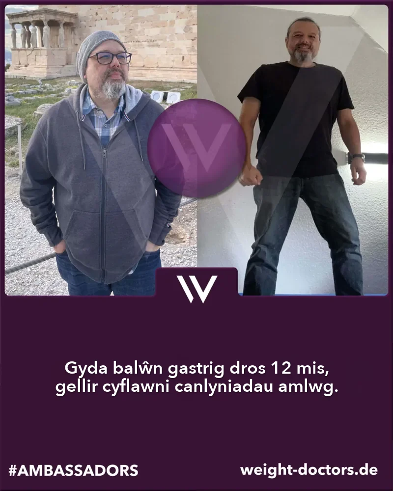 Weight Doctors® cyn ac ar ôl: claf cyn ac ar ôl deuddeg mis gyda'r Weight Doctors® BALŴN GASTRIG
