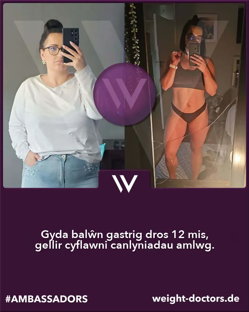 Weight Doctors® cyn ac ar ôl: cleifes cyn ac ar ôl deuddeg mis gyda’r Weight Doctors® BALŴN GASTRIG