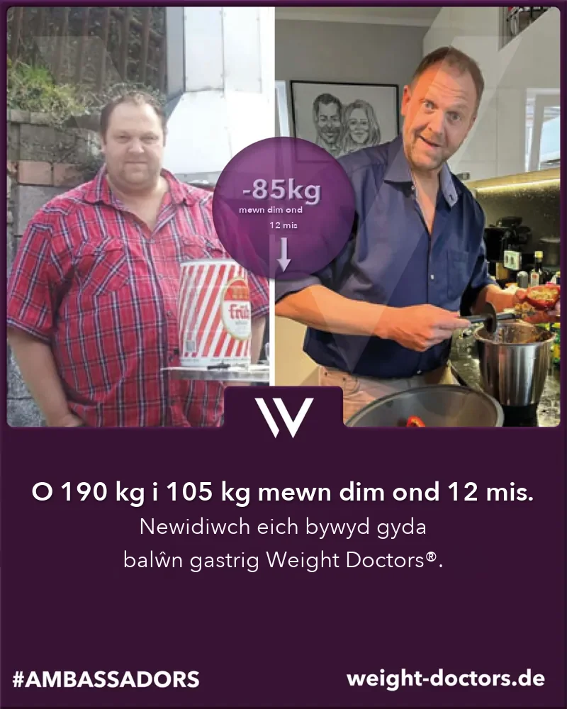 Weight Doctors® cyn ac ar ôl: claf gwrywaidd o 190 kg i 105 kg mewn deuddeg mis, gyda’r Weight Doctors® BALŴN GASTRIG