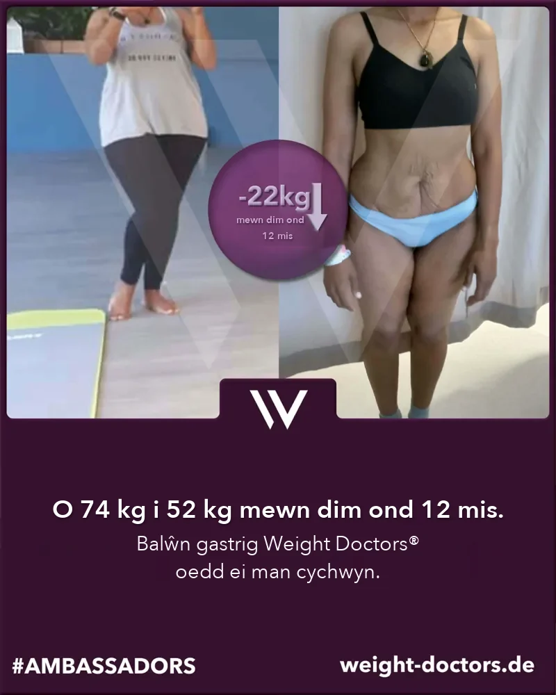 Weight Doctors® cyn ac ar ôl: claf o 74 kg i 52 kg mewn deuddeg mis, gyda'r Weight Doctors® BALŴN GASTRIG