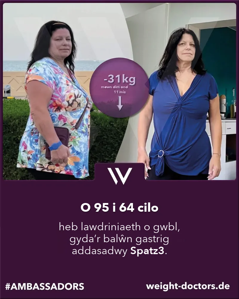 Weight Doctors® cyn ac ar ôl: claf o 95 i 64 kilo yn gyfan gwbl heb lawdriniaeth, gyda balŵn gastrig addasadwy Spatz3
