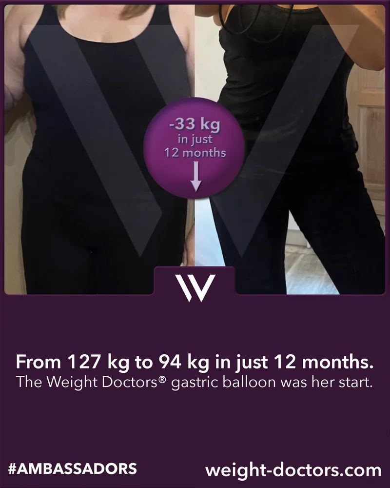Weight Doctors® before and after: female patient from 127 kg to 94 kg in twelve months, with the Weight Doctors® GASTRIC BALLOON
