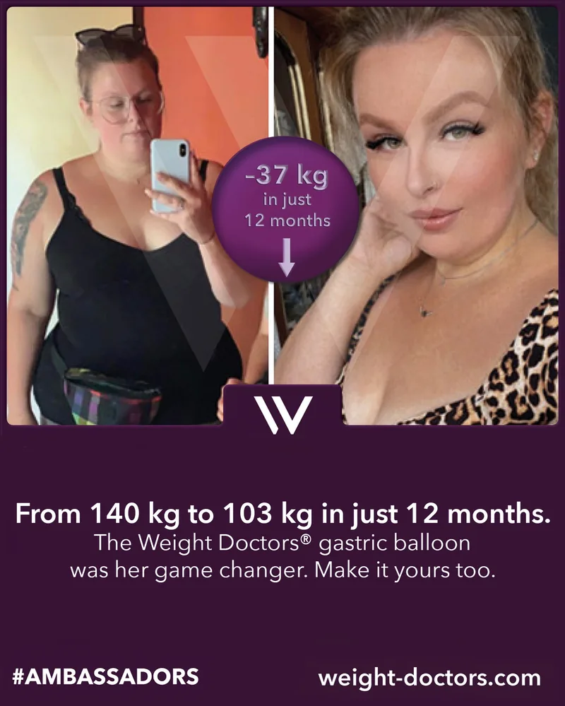 Weight Doctors® before and after: patient from 140 kg to 103 kg in twelve months, with the Weight Doctors® GASTRIC BALLOON