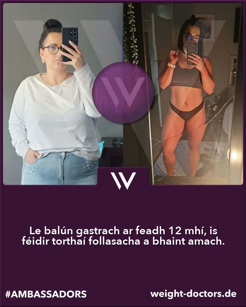 Weight Doctors® roimh agus tar éis: othar mná roimh agus tar éis dhá mhí dhéag le Weight Doctors® BALÚN GASTRACH