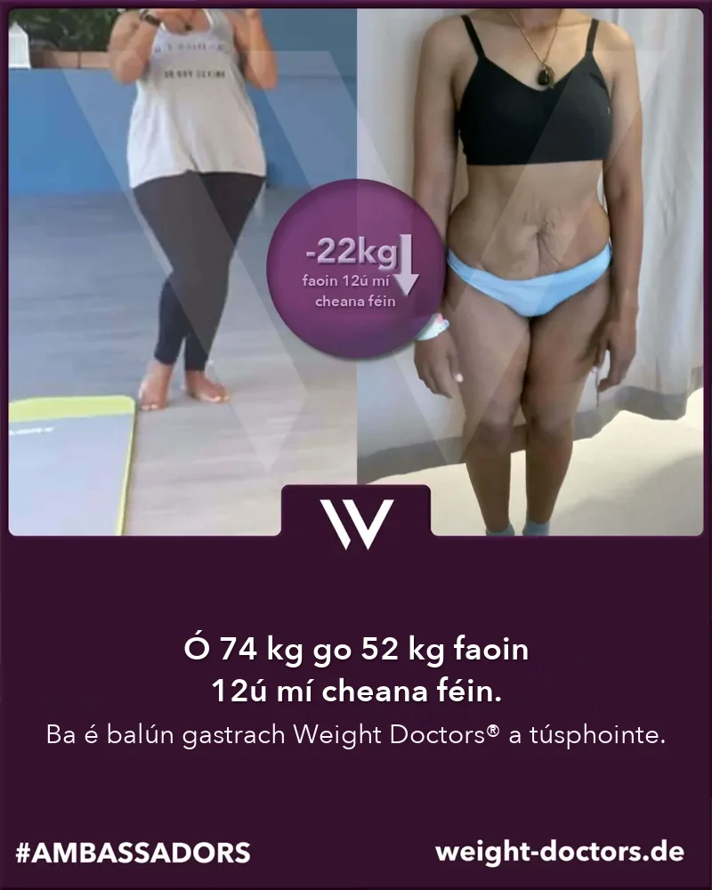 Weight Doctors® roimh agus tar éis: othar ó 74 kg go 52 kg i ndá mhí dhéag, leis an Weight Doctors® BALÚN GASTRACH