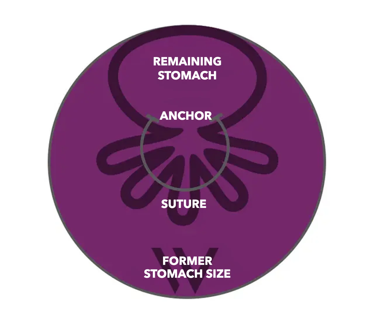 Diagram of OverStitch NXT™: anchors and suture gather the stomach wall, the remaining stomach is significantly smaller than the former stomach size