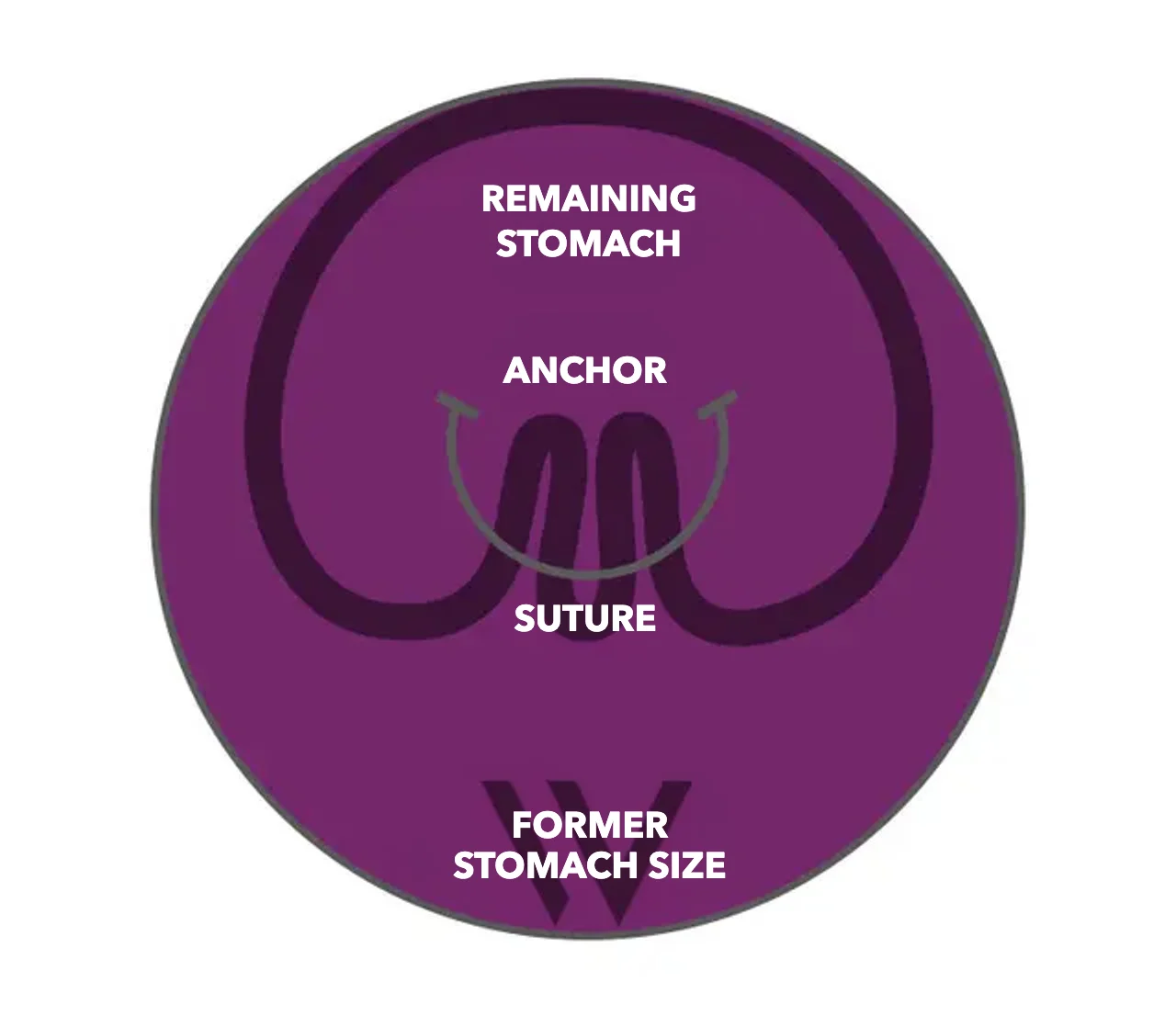 Schematic drawing: stomach after gathering with pose® 3.0 Double Helix – remaining stomach, anchors and suture within the former stomach size