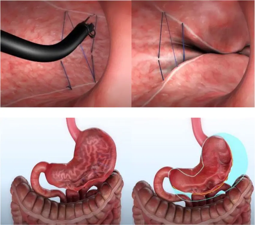 Endoscopic suturing with OverStitch NXT™: at the top, the endoscope suturing at the stomach wall; at the bottom, the stomach before and after, with the earlier size marked