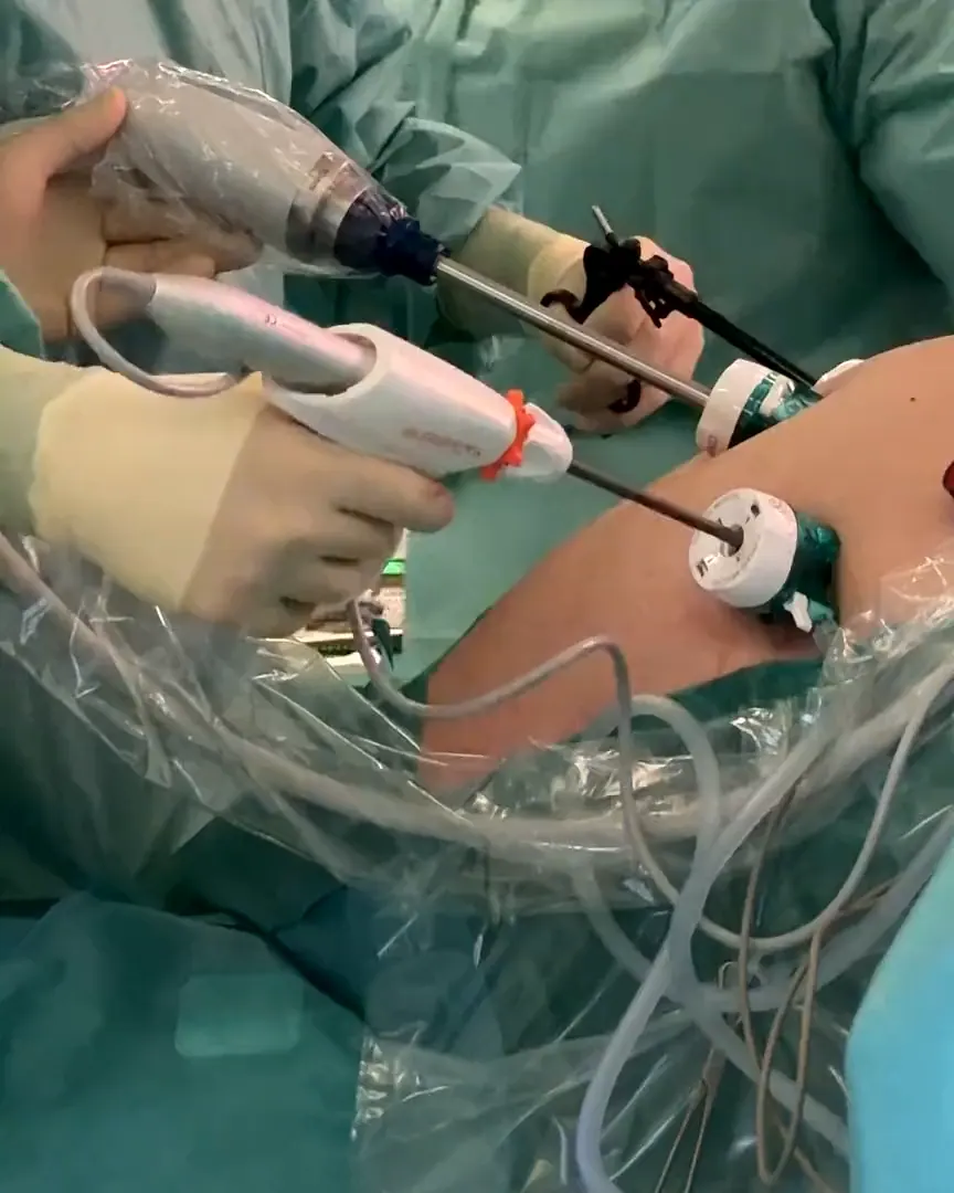 Hands of the surgical team guiding the instruments through small access points in the abdominal wall